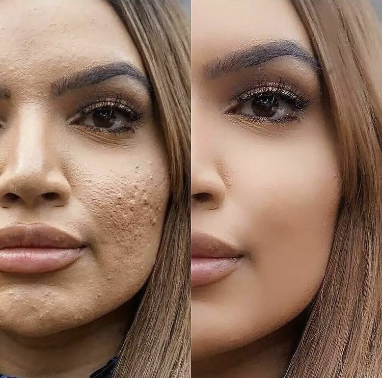 Instagram beauty filtri per correggere l'acne